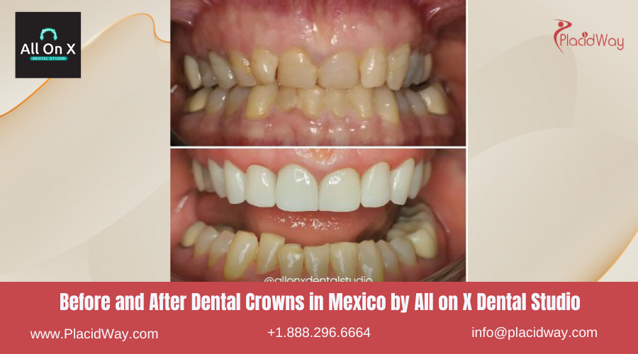 Dental Crowns in Mexico Before and After Image by All on X Dental Studio