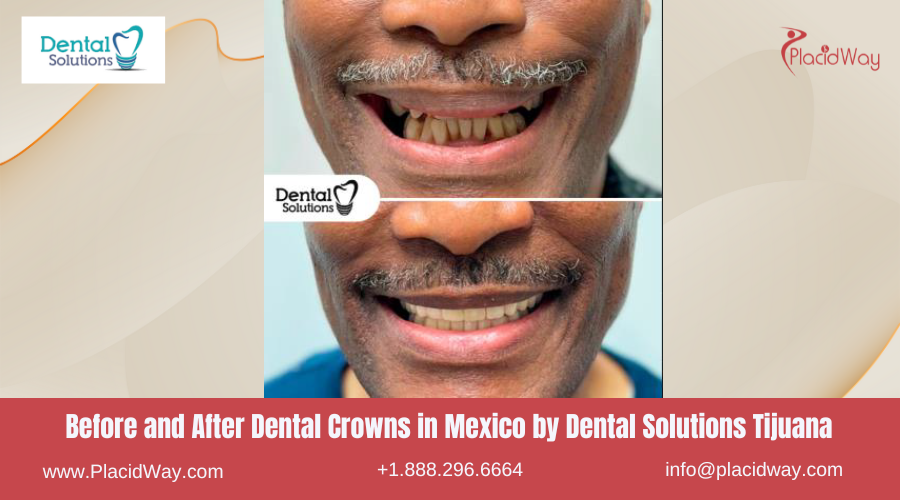 Dental Crowns in Mexico Before and After Image by Dental Solutions