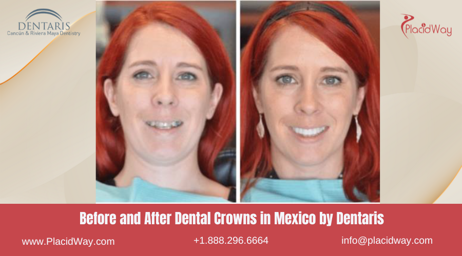 Dental Crowns in Mexico Before and After Image by Dentaris