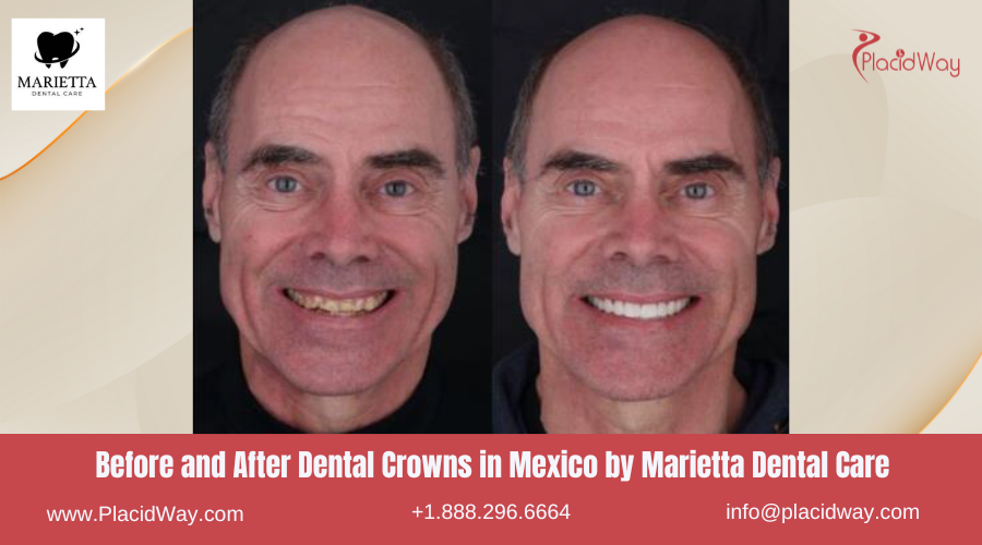 Dental Crowns in Mexico Before and After Image by Marietta Dental Care