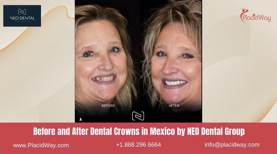 Dental Crowns in Mexico Before and After Image by NEO Dental Group