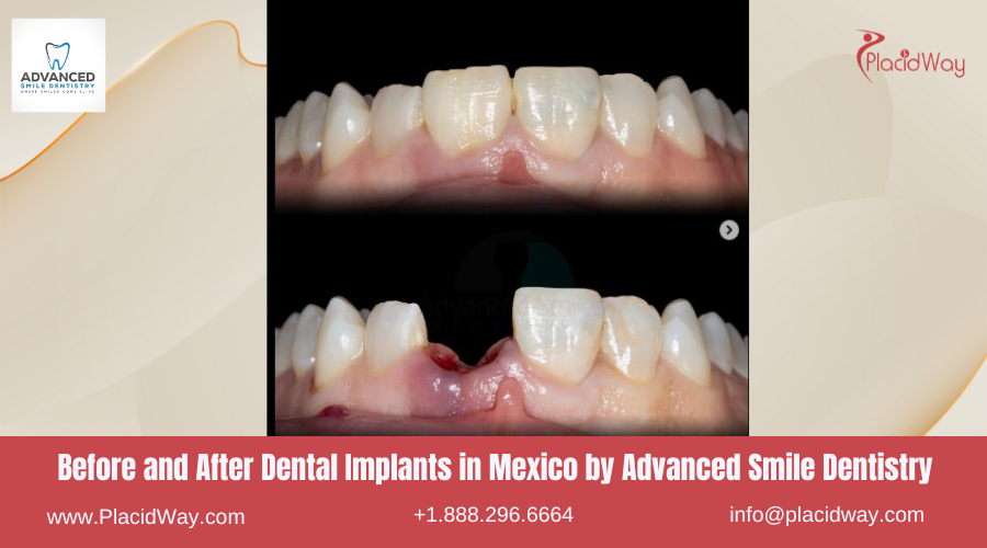 Dental Implants in Mexico Before and After Image by Advanced Smile Dentistry 1