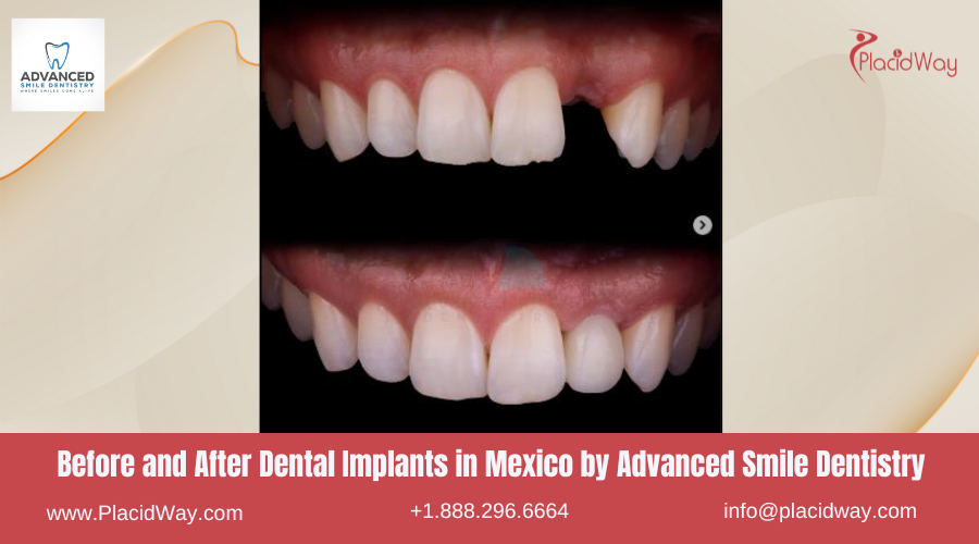 Dental Implants in Mexico Before and After Image by Advanced Smile Dentistry