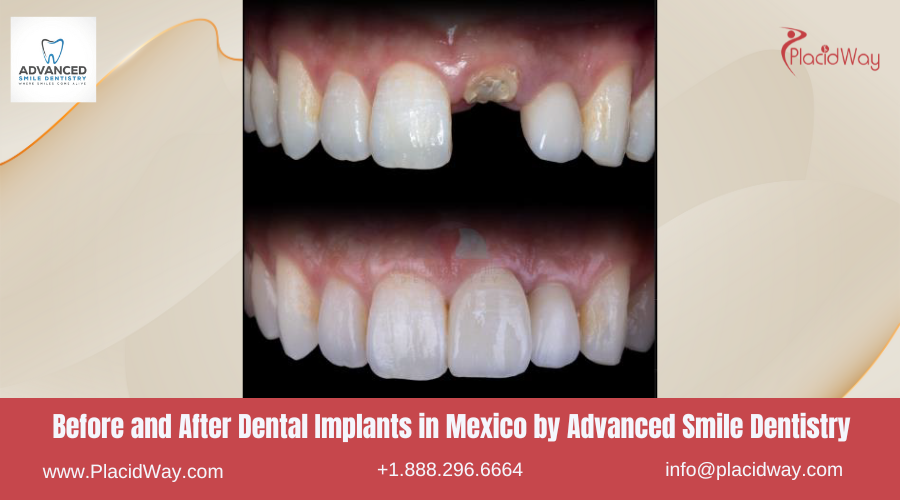 Dental Implants in Mexico Before and After Image by Advanced Smile Dentistry