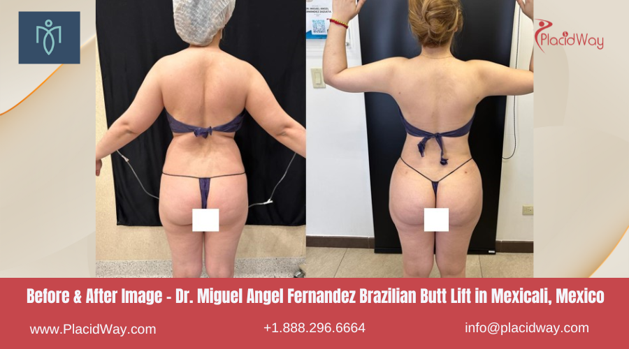 Brazilian Butt Lift in Mexicali Mexico