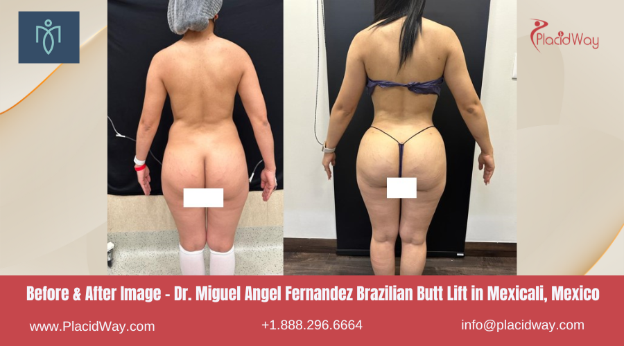 Brazilian Butt Lift in Mexicali Mexico