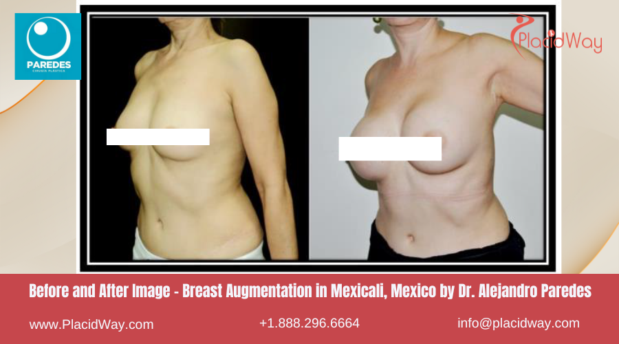 Breast Augmentation in Mexicali Mexico