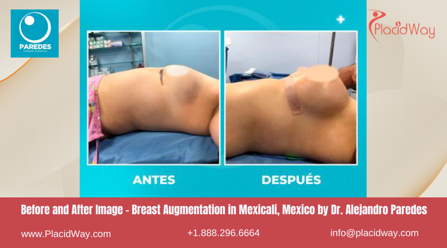 Breast Augmentation in Mexicali Mexico