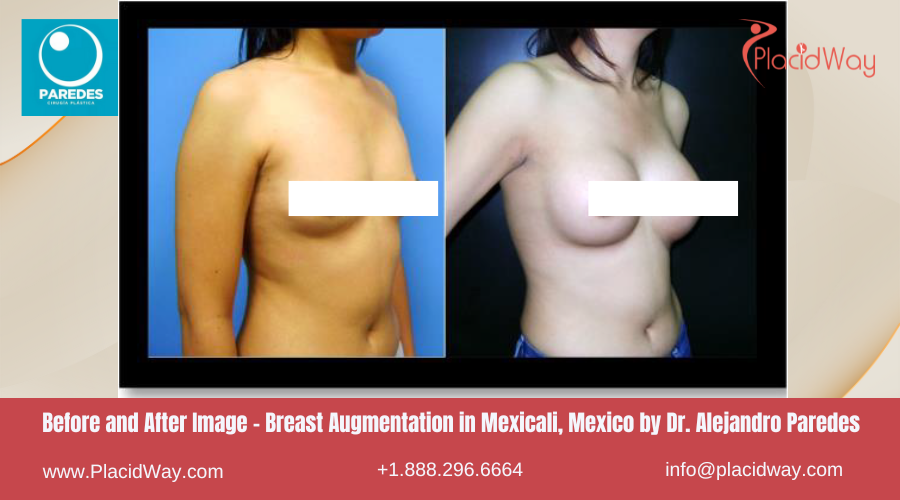 Breast Augmentation in Mexicali Mexico