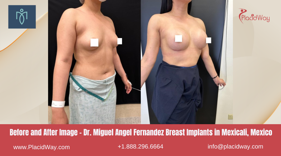 Breast Augmentation in Mexicali Mexico