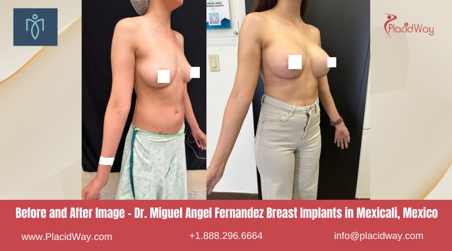 Breast Augmentation in Mexicali Mexico