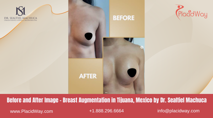 Breast Augmentation in Tijuana, Mexico