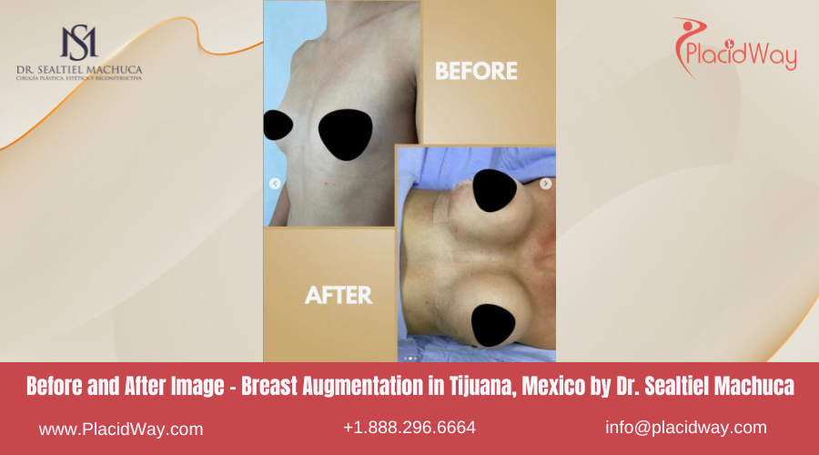 Breast Augmentation in Tijuana, Mexico