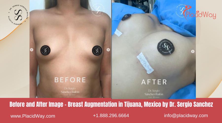 Breast Augmentation in Tijuana, Mexico