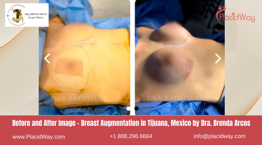 Breast Augmentation in Tijuana, Mexico