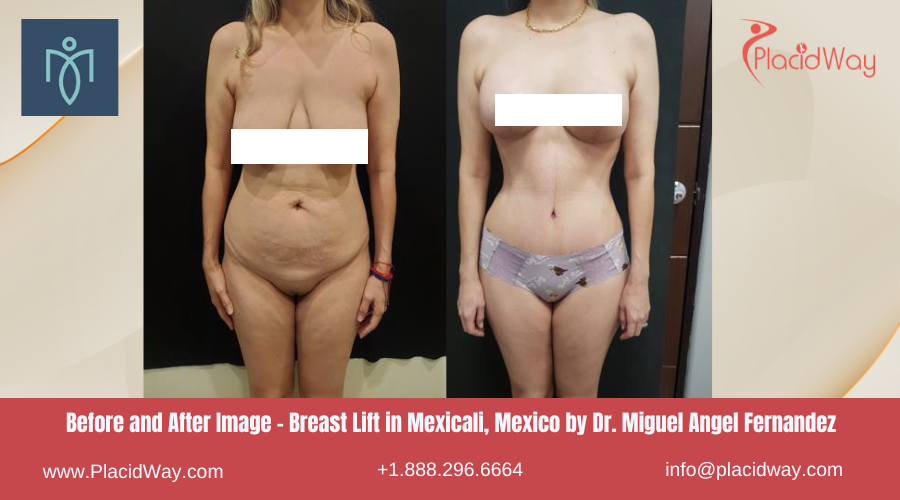 Breast Lift in Mexicali Mexico