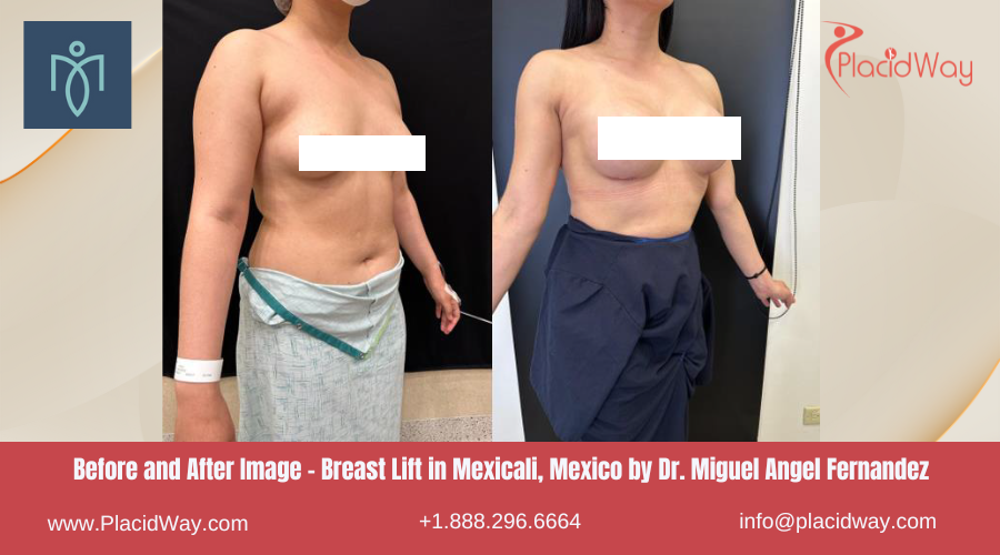 Breast Lift in Mexicali Mexico