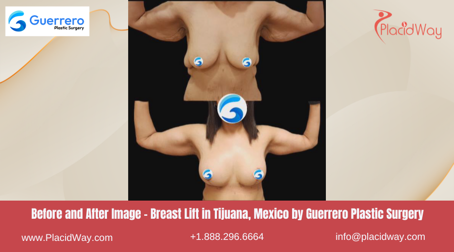 Breast Lift in Tijuana Mexico