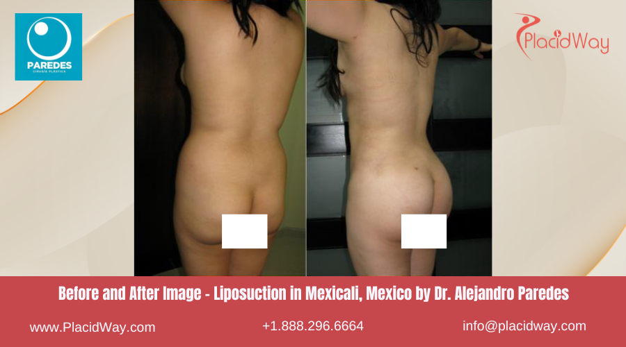 Liposuction in Mexicali Mexico