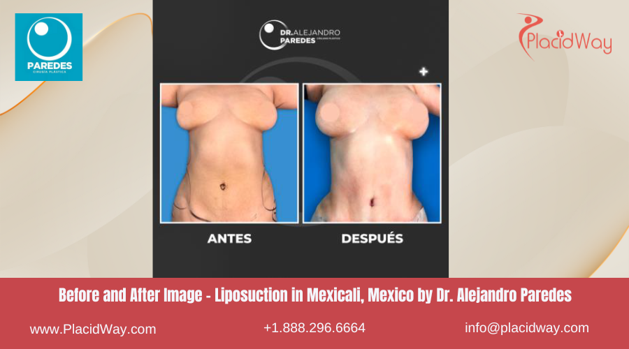 Liposuction in Mexicali Mexico