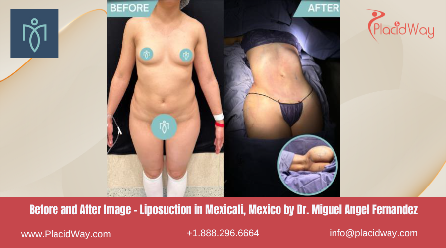 Liposuction in Mexicali Mexico