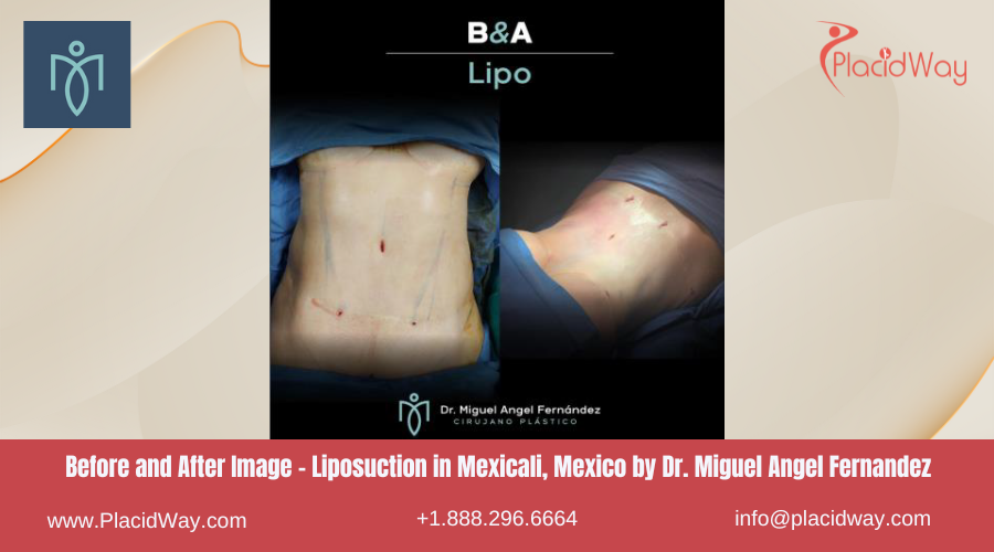 Liposuction in Mexicali Mexico