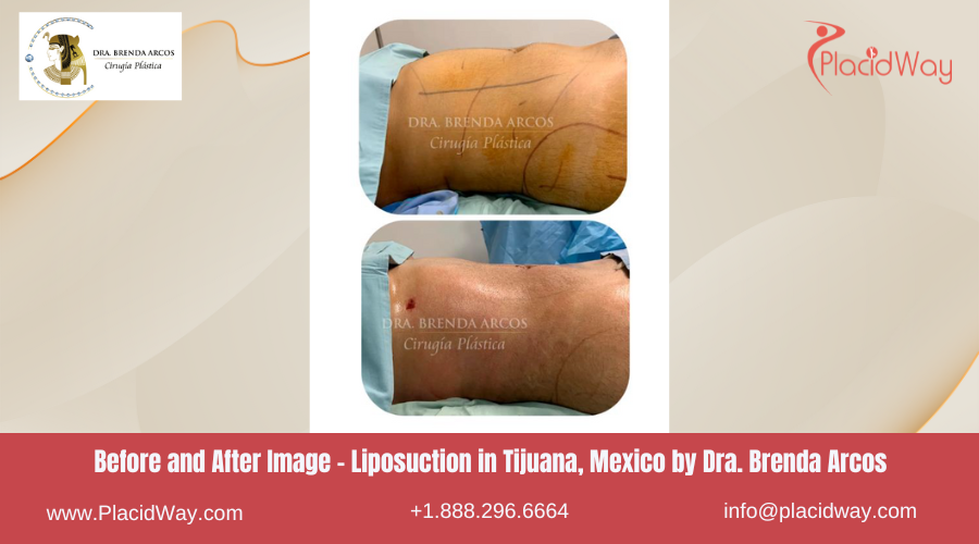 Liposuction in Tijuana Mexico