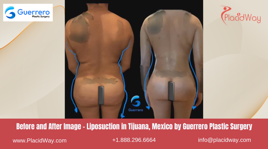 Liposuction in Tijuana Mexico