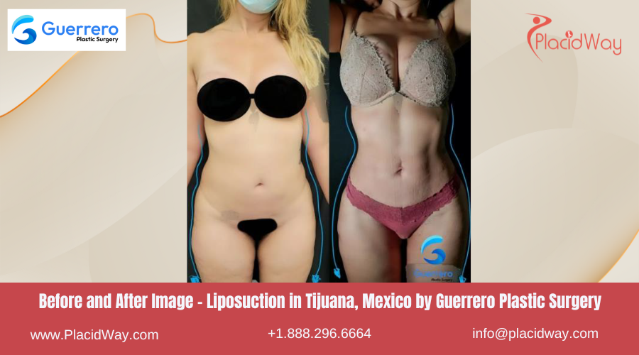 Liposuction in Tijuana Mexico