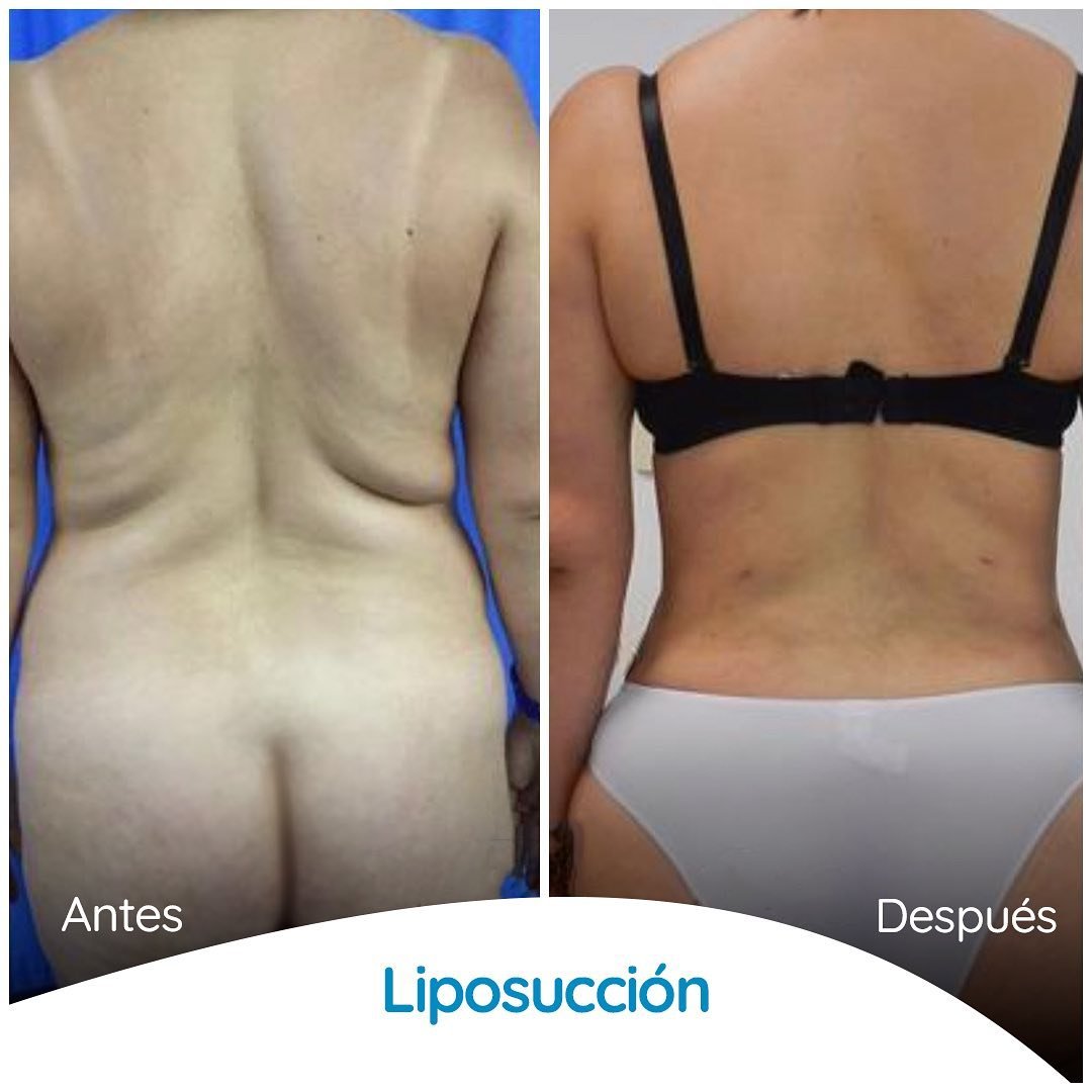 Dr. Alvaro Uribe - Colombia Plastic Surgery