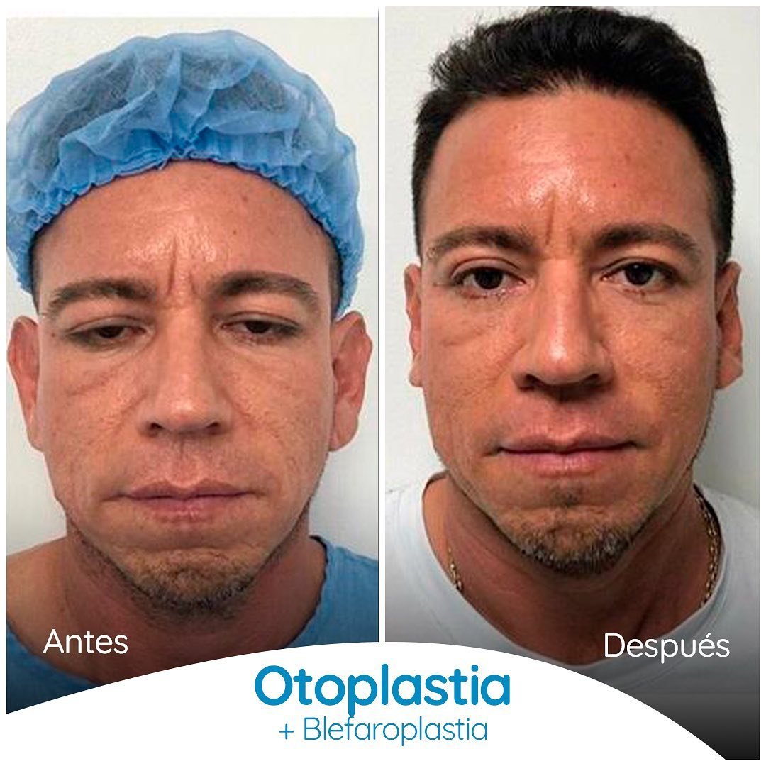 Dr. Alvaro Uribe - Colombia Plastic Surgery