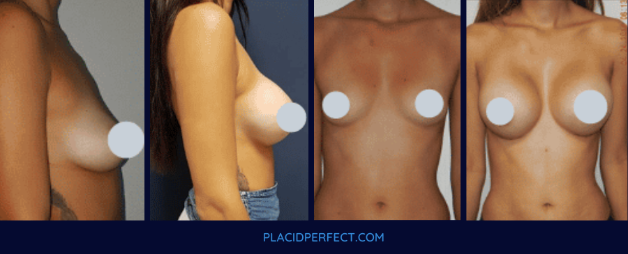 Before and After Breast Augmentation in Mexico