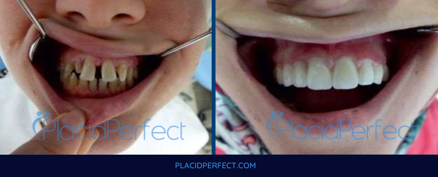 Before and After Dental Implants in Colombia