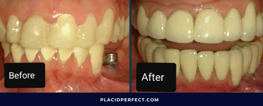 Before and After Dental Implants in Costa Rica