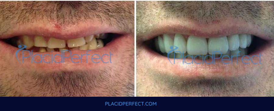 Before and After Dental Veneers in Costa Rica