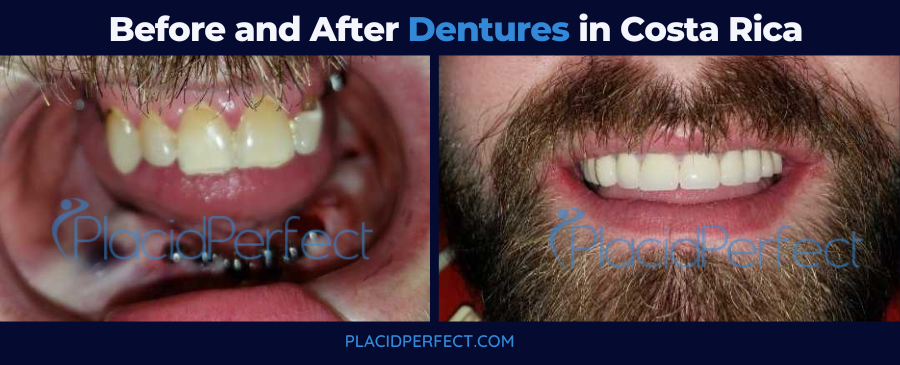 Before and After Dentures in Costa Rica
