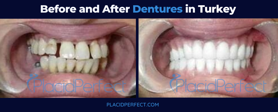 Before and After Dentures in Turkey