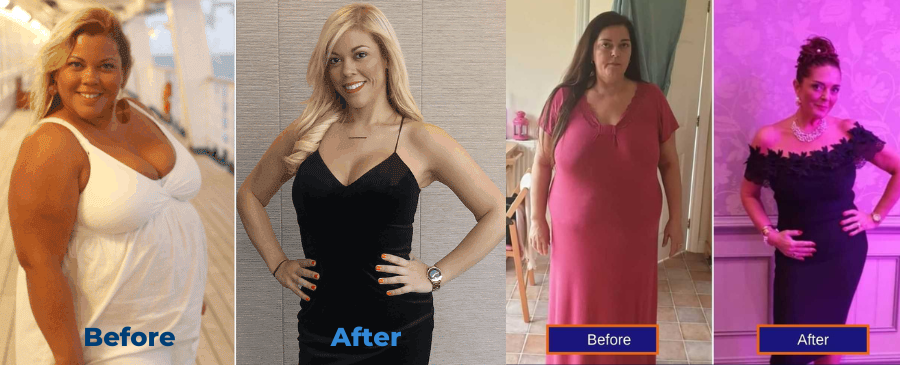 Before and After Gastric Bypass in Turkey