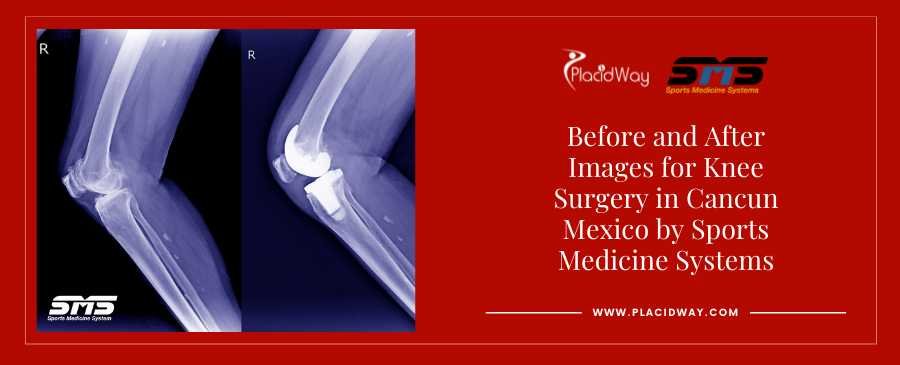 Before and After Knee Surgery in Mexico