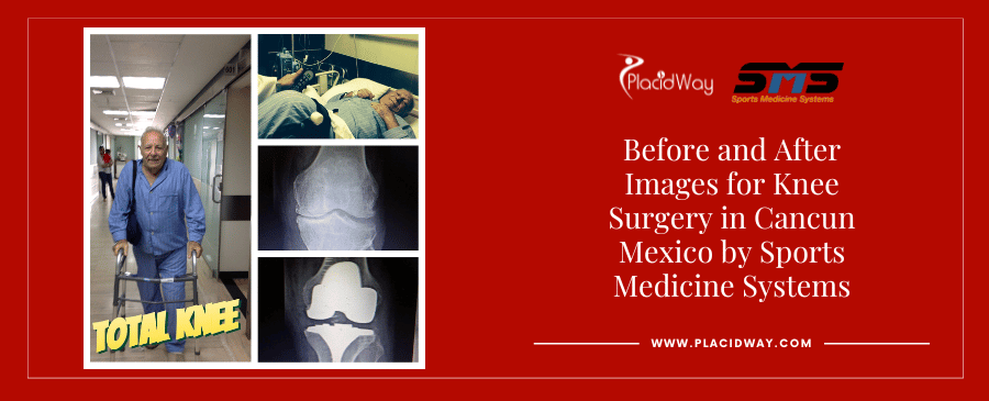 Before and After Knee Surgery in Mexico