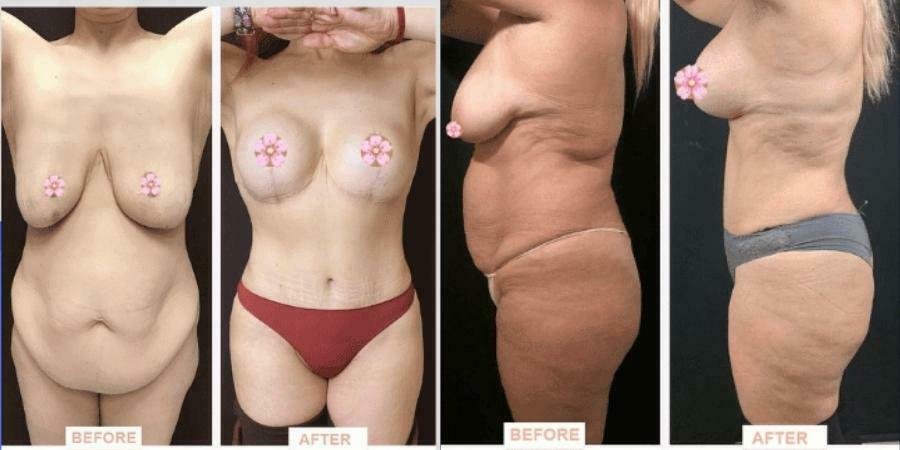 Before and After Liposuction in Istanbul Turkey