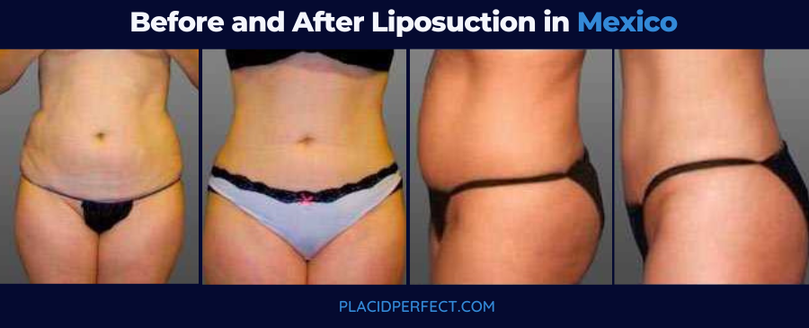 Before and After Liposuction in Mexico
