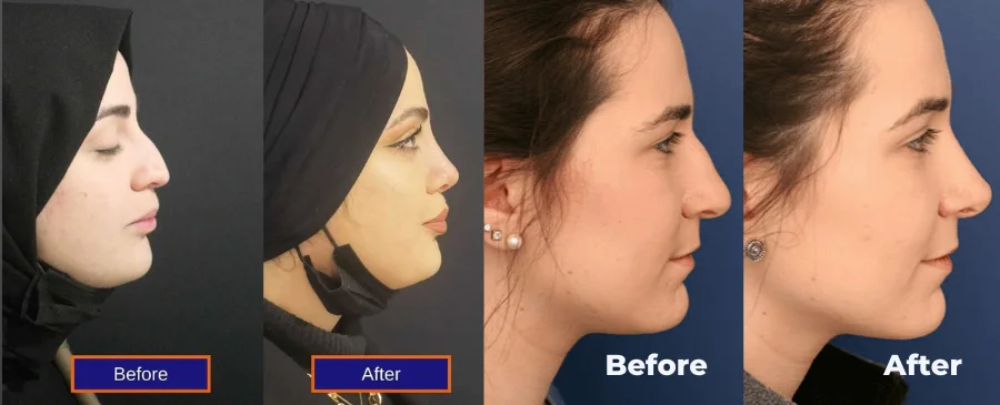 Before and After Rhinoplasty in Turkey Before and After Rhinoplasty in Turkey
