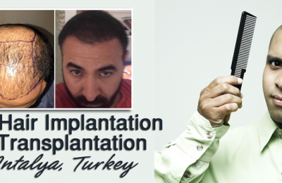 DHI-hair-transplant-in-Antalya,-Turkey