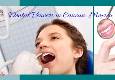 Dental Veneers in Cancun, Mexico